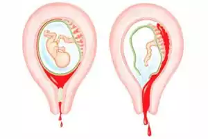 Incomplete Abortion after Medical Abortion